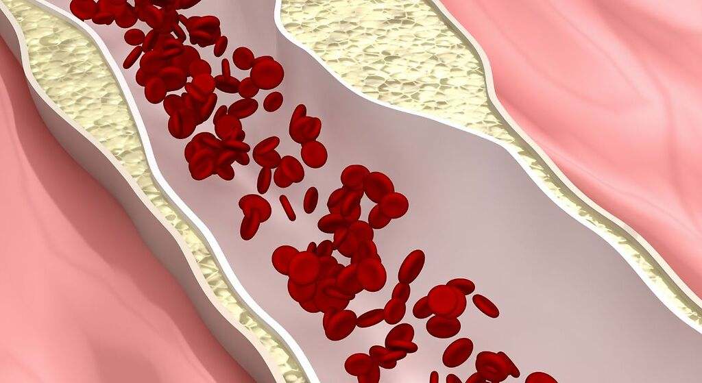 Jak rychle a přirozeně snížit hladinu cholesterolu: pět domácích prostředků